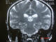موش چاق :  كورونال T2 از MRI مغز : بدن موش شامل ساقه مغز، صورت و چشم‌ها در سيسترن كوادري جمينال و بطن‌هاي طرفي بجاي گوش‌ها