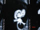 موجود ظريفي كه داراي شكل عجيبي مثل اسب آبي است: بازسازي اندولنف گوش داخلي FIESTA در MRI
