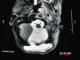 خرس سفيد قطبي :  T2 از MRI آكسيال فوساي خلفي عمل شده