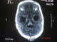 پسر شجاع :  آكسيال T1 از MRI مغز
