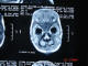پسر شجاع :  آكسيال T1 از MRI مغز