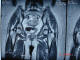 لگن ترسيده :  صورت دماغ گنده، چشم تنگ، دهن گشاد: كورونال لگن با MRI و T1