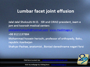 Lumbar-facet-joint-effusion